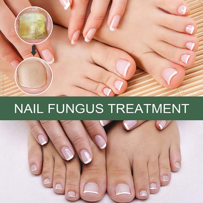FungiFreeze™ — Unlock Clear, Healthy Nails and Step Out with Confidence
