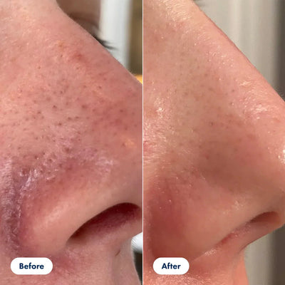 SilkRadiance™ Exfoliant — Glow Fearlessly with Silky, Poreless Skin Every Day