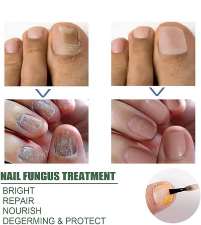 FungiFreeze™ — Unlock Clear, Healthy Nails and Step Out with Confidence