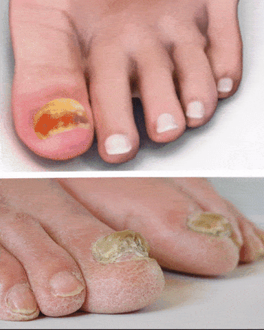 DermiPure™ Nail Rescue — Clear, Confident Nails You'll Love to Show Off Fast